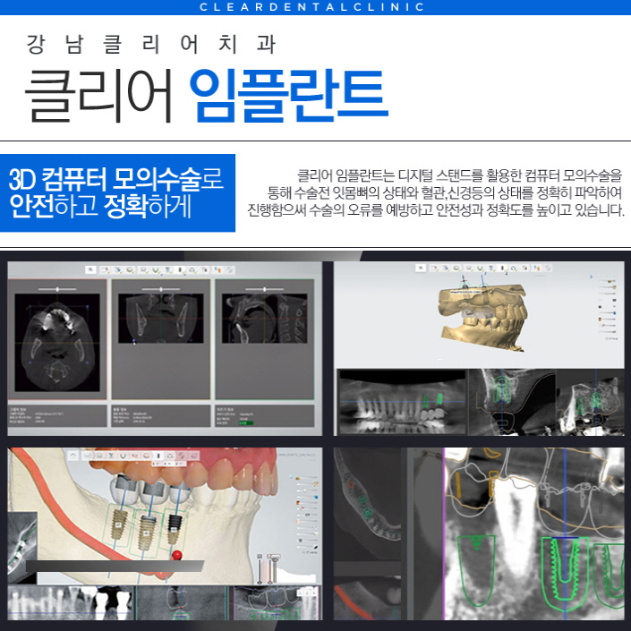 강남역임플란트치과 선택의 기준 관련 이미지 7