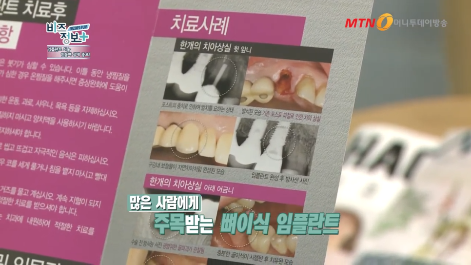 강남역임플란트치과 뼈이식 방법으로 보다 탄탄하게 관련 이미지 3
