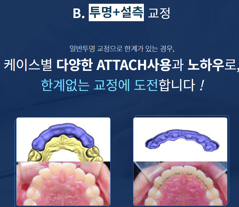 도곡동교정치과 반듯한 치아를 갖기 위한 준비 관련 이미지 8