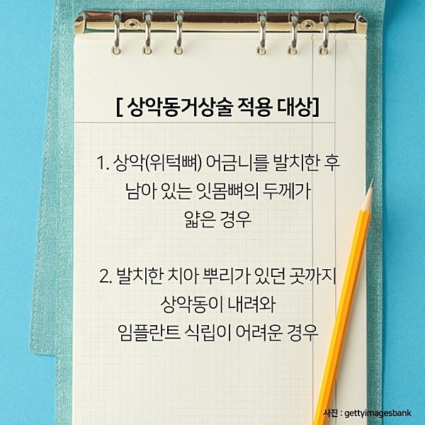 잇몸뼈가 부족해 임플란트 수술 어렵다면? 관련 이미지 9