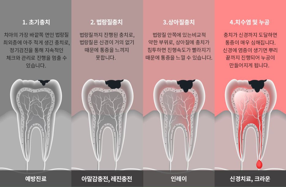 충치 레진치료 치아 갈색점 검은점이 보이면 서둘러야 관련 이미지 3