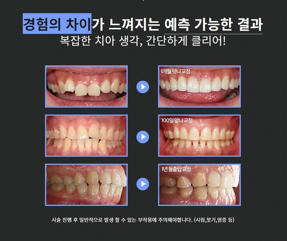 클리어치과 교정 아무데서나 말고 신중하게 관련 이미지 6