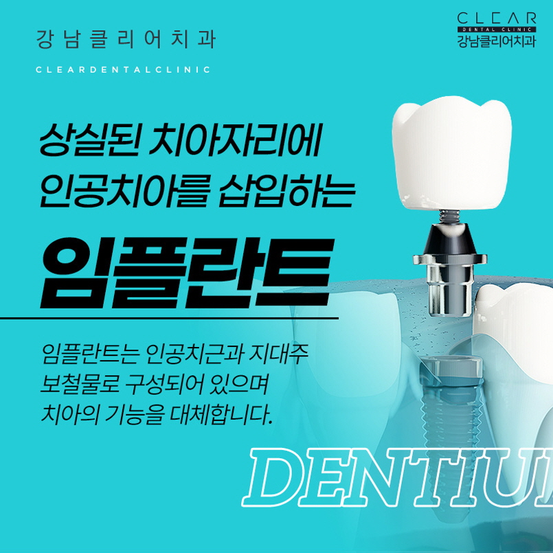 강남역임플란트 나에게 맞는 맞춤형 임플란트로 관련 이미지 2