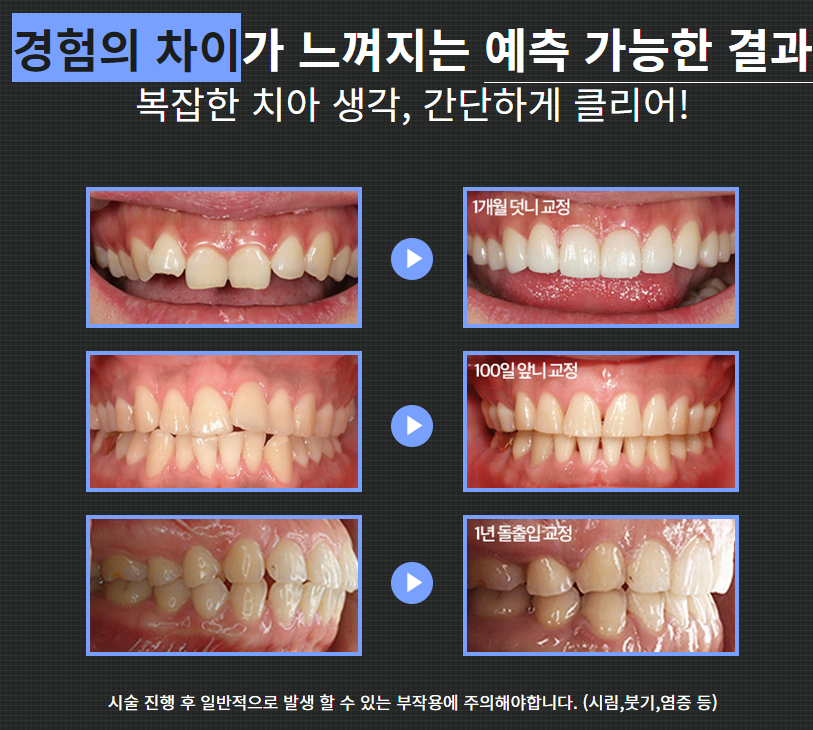 도곡동치아교정치과 보기좋은 치열을 원한다면 관련 이미지 5