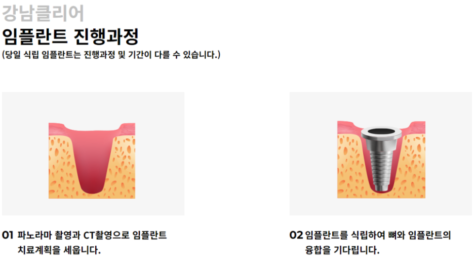 논현동 임플란트 식립 중요한 것은? 관련 이미지 2
