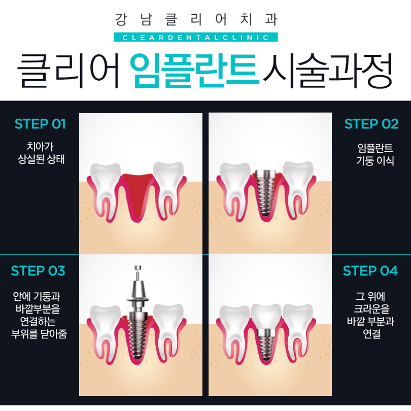 강남역임플란트 나에게 맞는 맞춤형 임플란트로 관련 이미지 3