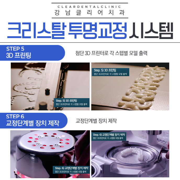 강남투명교정 치과 기존 투명교정 문제점 보완 관련 이미지 7