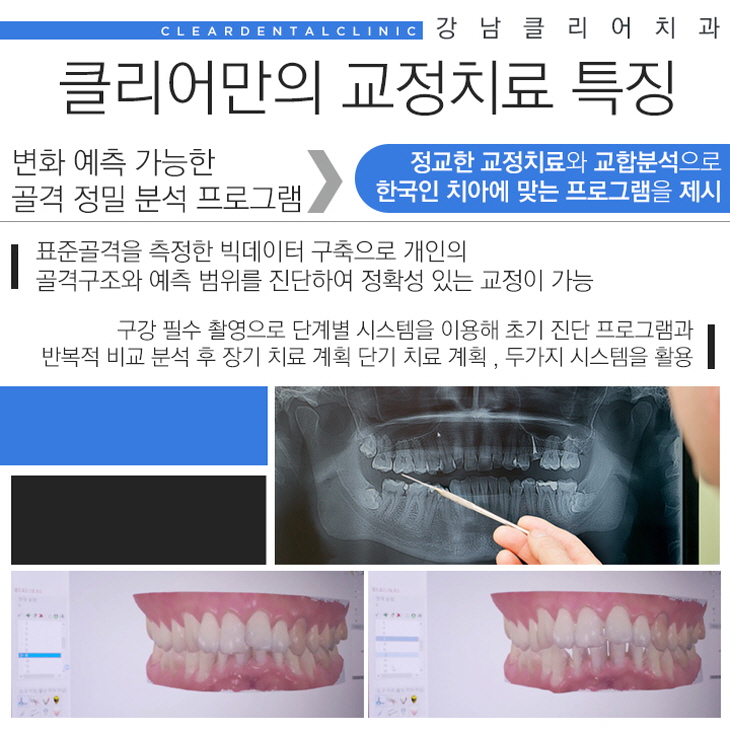 강남역 설측교정 콤보교정부터 맞춤형 설측교정 인코그니토 까지 관련 이미지 10