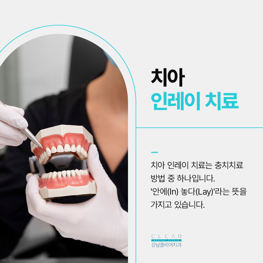 치아 인레이 이럴때 필요해요 관련 이미지 3