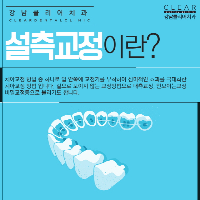 강남치아교정잘하는치과 치아교정종류 특징 관련 이미지 5