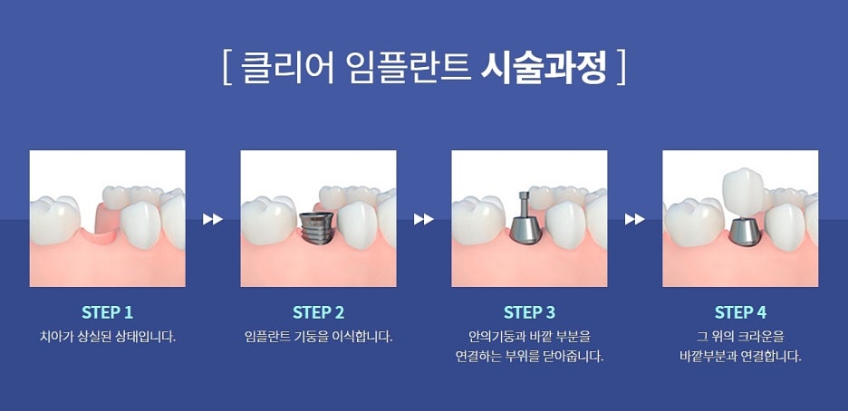 강남 임플란트 치과 집도의 역량을 파악하고 관련 이미지 4