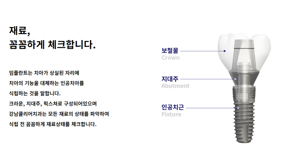 강남 임플란트치과 탄탄한 고정력과 편의성 관련 이미지 5