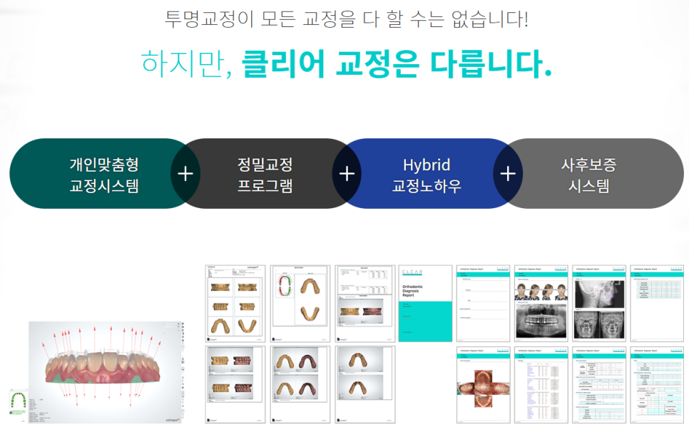 서초동치아교정치과 치열을 보기 좋게 관련 이미지 5