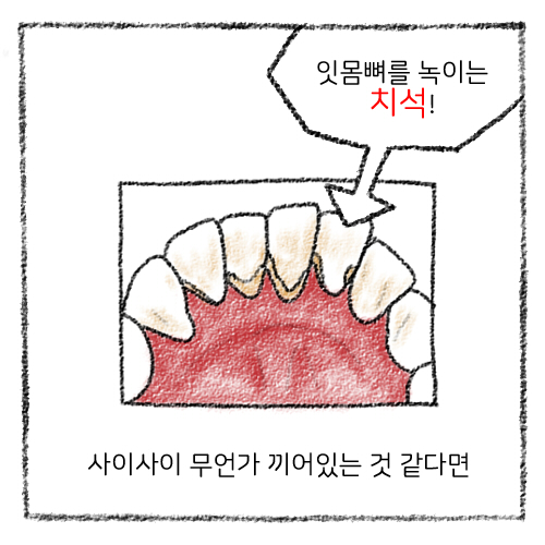 치아 스케일링 보험적용, 가격, 스케일링 후 주의사항 관련 이미지 8