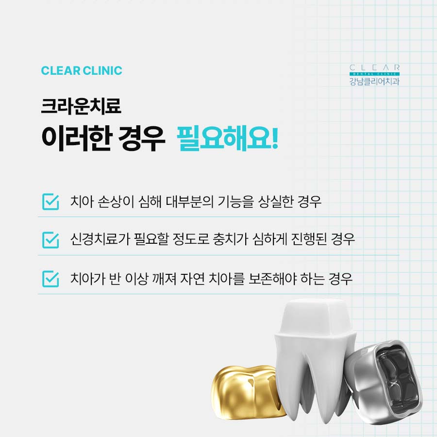 치아보철치료 크라운 치료가 필요한 경우는 관련 이미지 3