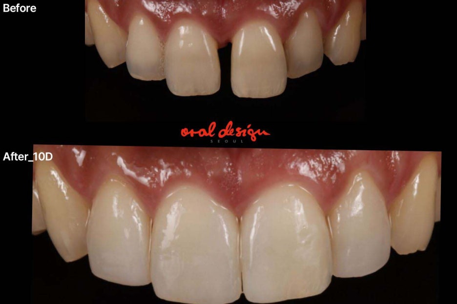 강남클리어치과 라미네이트 적절한 치아삭제가 관건 관련 이미지 6