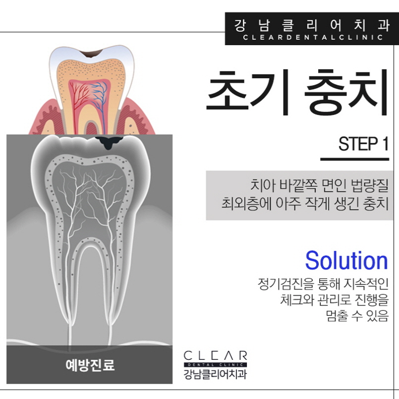 강남충치치료 빠르면 빠를수록 좋습니다. 관련 이미지 4