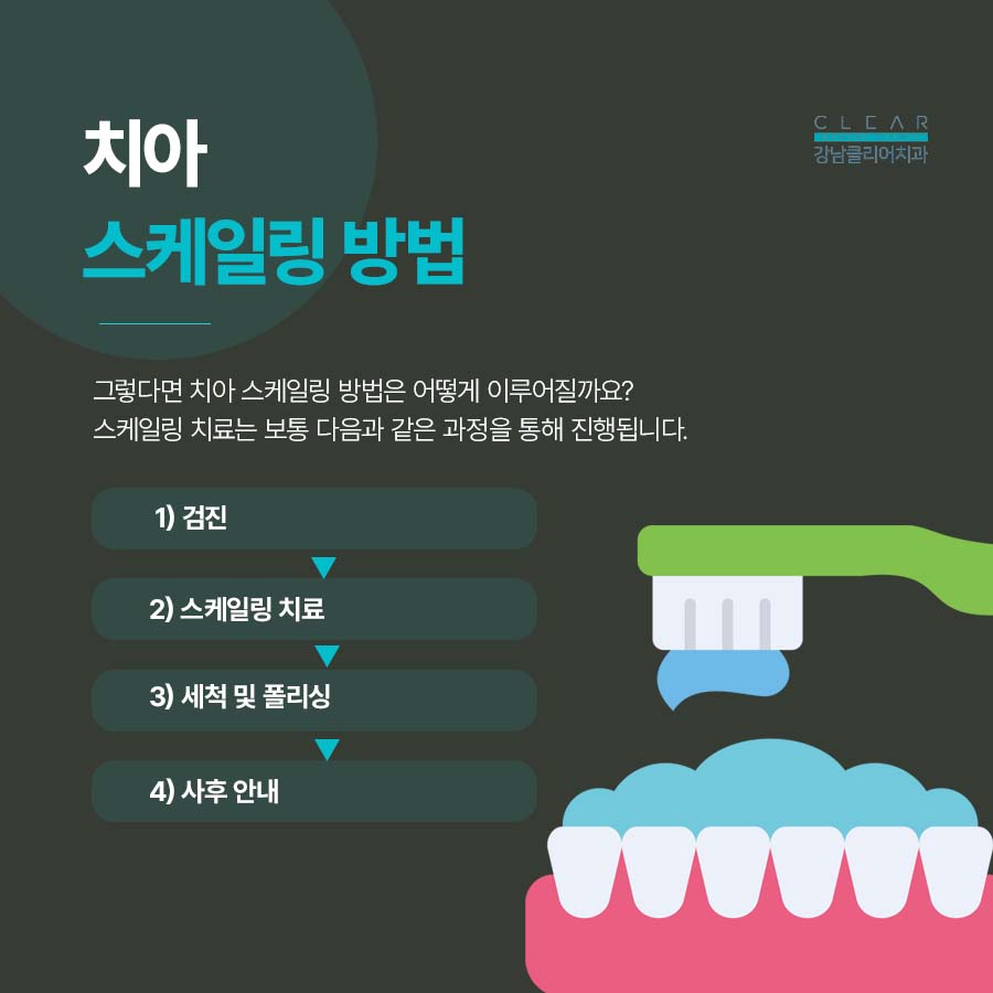 치아 스케일링 주기 적절한 정도 방법에 대해 관련 이미지 4
