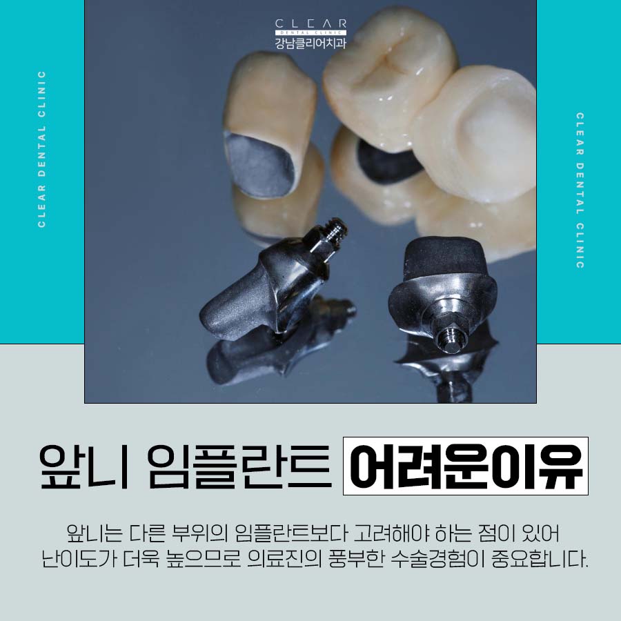 앞니발치 임플란트 난이도가 높은 이유 관련 이미지 2
