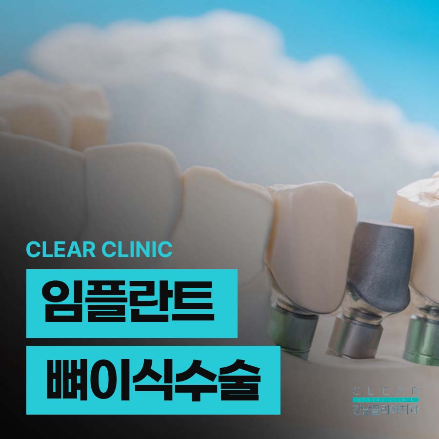 임플란트뼈이식수술 뼈이식 종류 주의사항은? 관련 이미지 1