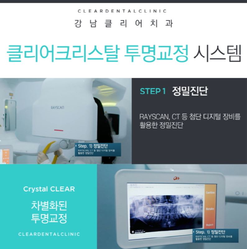 강남역투명교정 자연스러운미소를 가져보세요! 관련 이미지 5