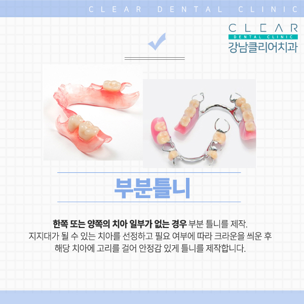 강남역치과 추천 치아 보철치료 관련 이미지 8