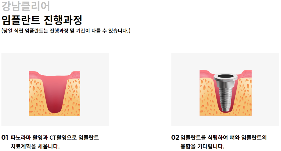 서초동임플란트치과 측방력까지 고려한 치료 관련 이미지 4
