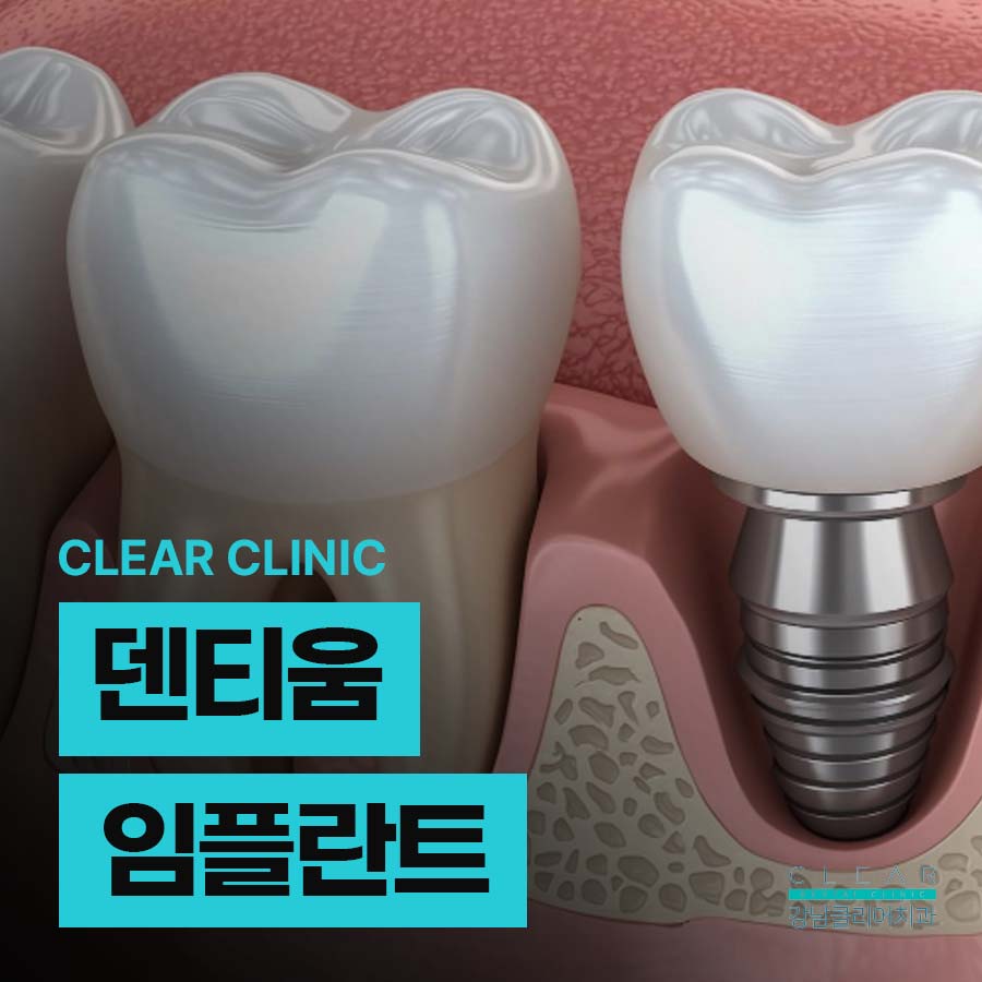 덴티움 임플란트 정품을 사용이 중요 관련 이미지 1