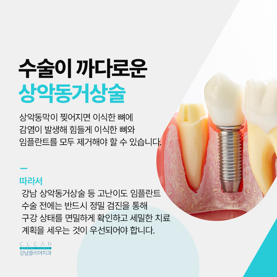 강남클리어치과 상악동에 주목해야해요 관련 이미지 4