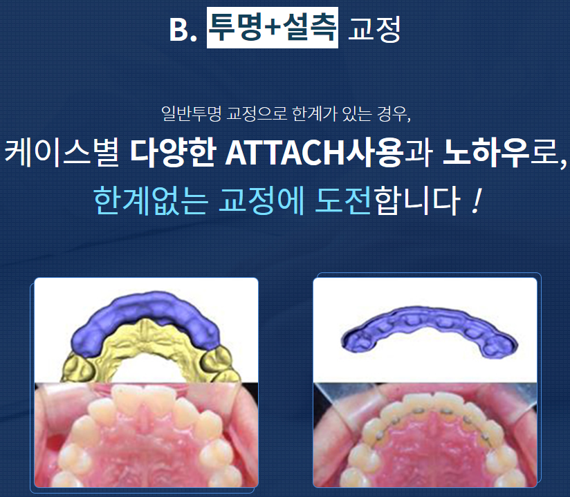서울치아교정치과 내 케이스에 맞는 방법은? 관련 이미지 8