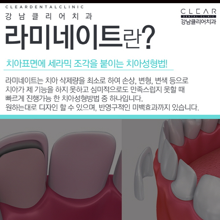 강남라미네이트 앞뒤옆까지 확실하게하자! 관련 이미지 2