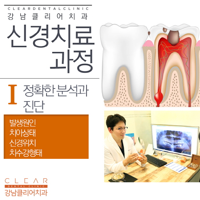 치과신경치료, 신경치료 후 크라운 꼭 해야하는걸까? 관련 이미지 5