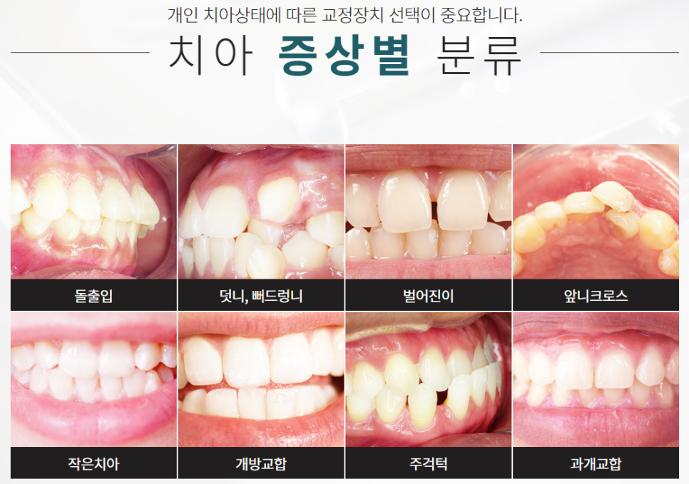 강남교정치과 치아라인을 반듯하게! 관련 이미지 2