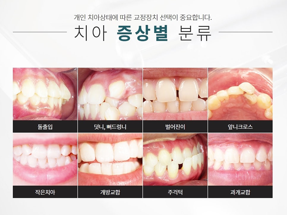 클리피씨 강남클리어 교정 전후도 궁금해 관련 이미지 4