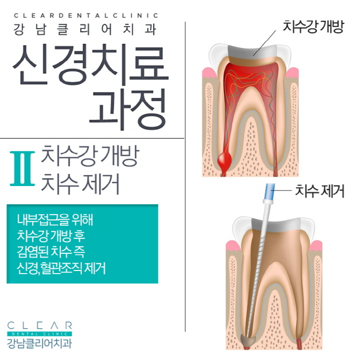 치아 신경치료 가볍고 쉽게 생각해선 안된다 관련 이미지 5