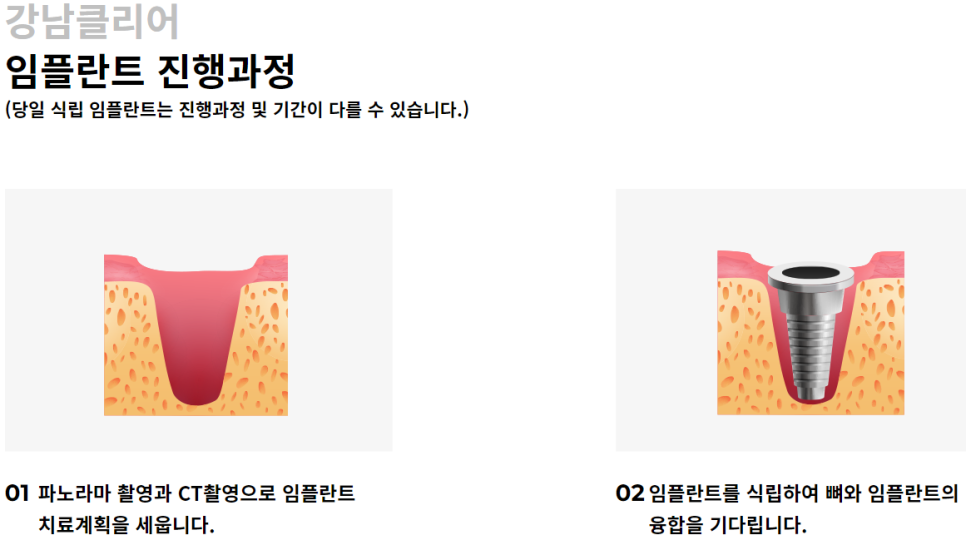 20대 임플란트 잘하는곳 강남치과 선택해봐요! 관련 이미지 6