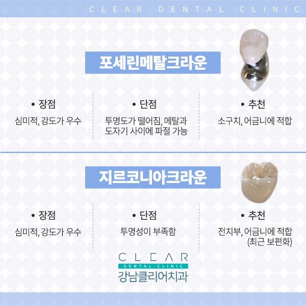 강남역치과 추천 치아 보철치료 관련 이미지 6