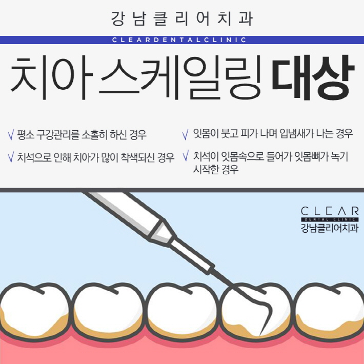 치아 스케일링 가격 건강보험 적용으로 부담없이 관련 이미지 3