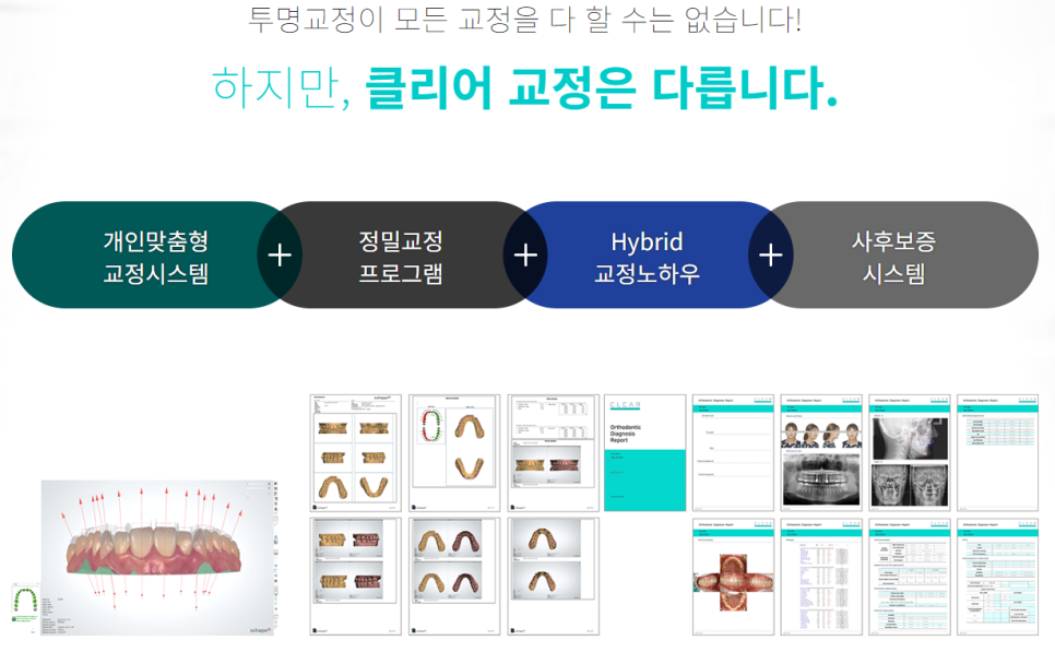 강남역투명교정 심미성을 만족할 수 있는 관련 이미지 8