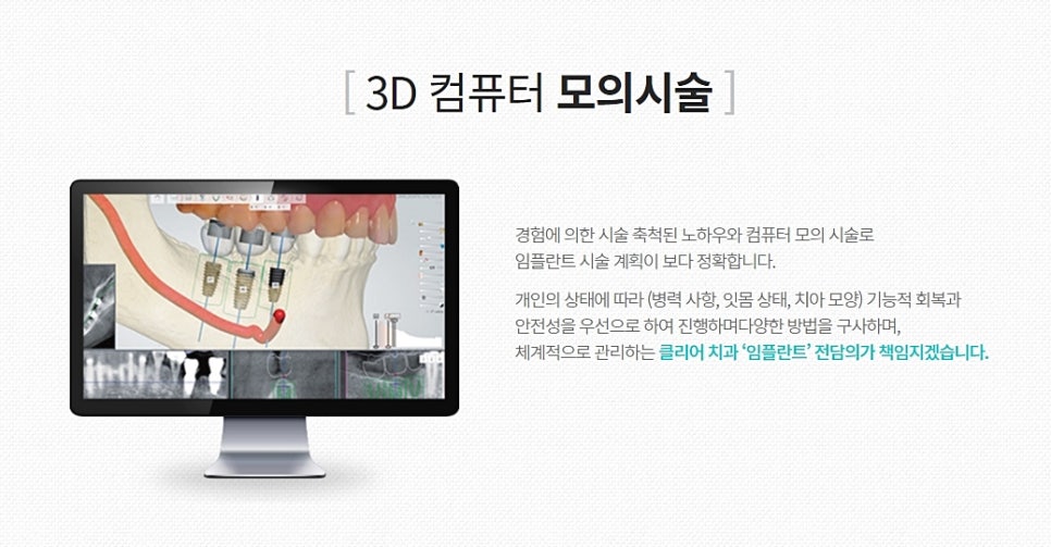 클리어치과 임플란트 이젠 고민 그만하고 관련 이미지 3