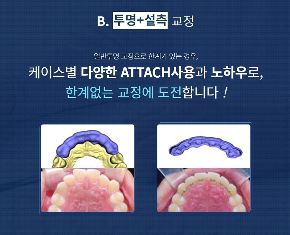 강남역 치아교정 정밀하게 다가가는 곳과 관련 이미지 3