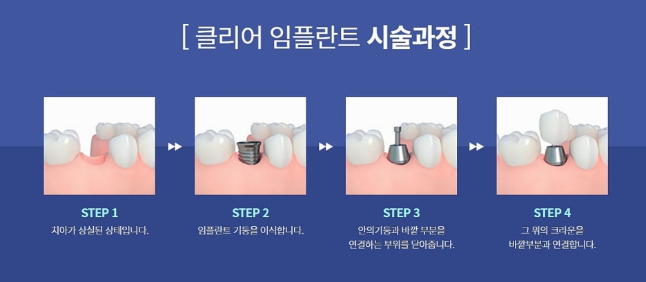 강남 임플란트치과 상황을 봐가면서 관련 이미지 3