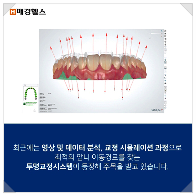클리어 치과 상식 - 앞니 부분교정 전 꿀팁! 관련 이미지 9