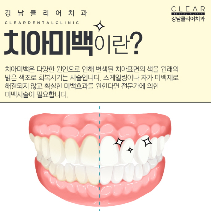 원데이치아미백 치과 치아미백 이벤트로 착한가격까지 관련 이미지 3