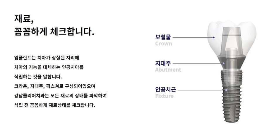 강남역 임플란트치과 상세하게 알아본 후 관련 이미지 4