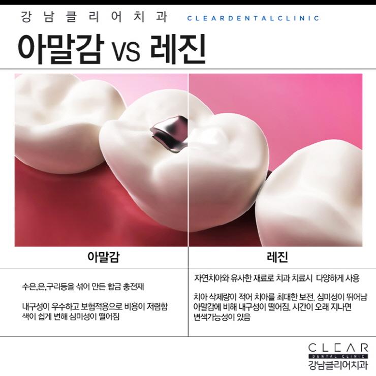 충치치료방법 단계별 필요한 보철치료까지 관련 이미지 5