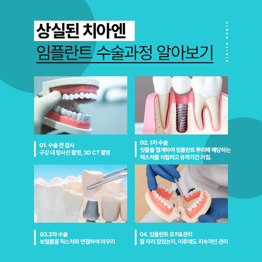 강남역 임플란트 치과 수술과정 및 시간 정리 관련 이미지 3