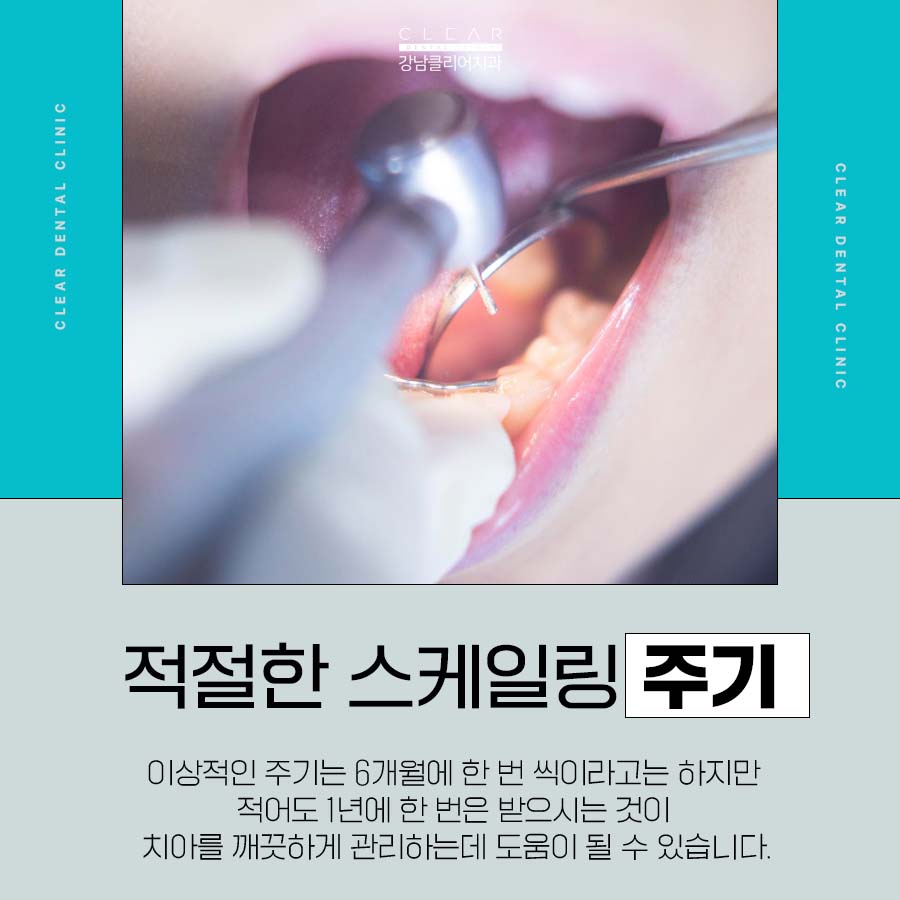 치아 스케일링 주기 적절한 정도 방법에 대해 관련 이미지 3