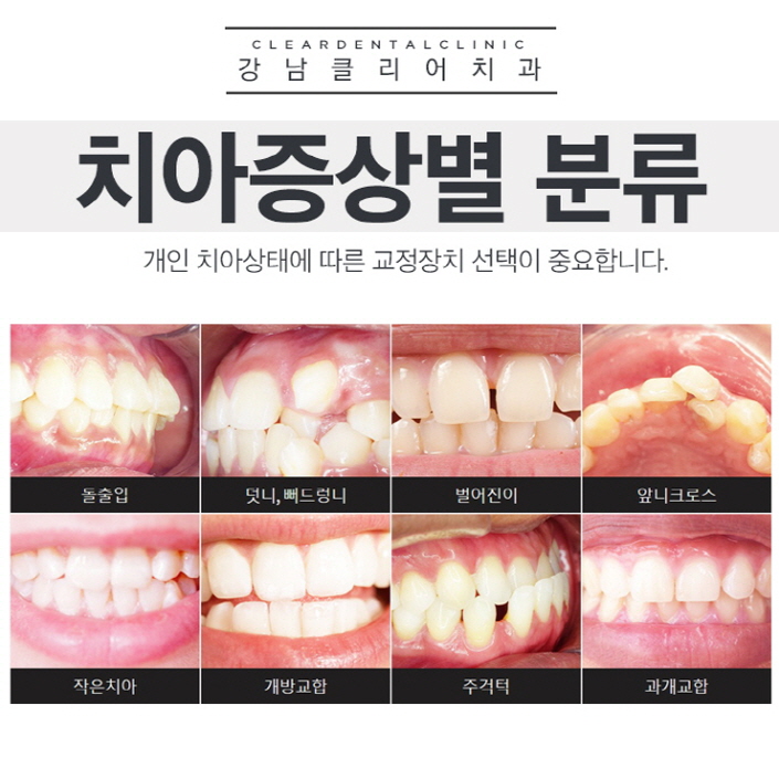 클리피씨교정치과에서 알려주는 장점들 관련 이미지 3