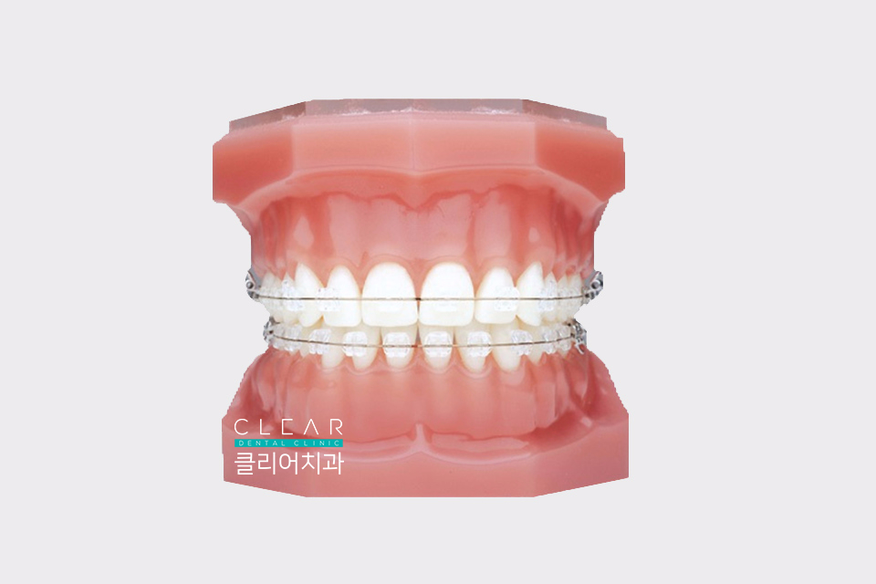 치아 교정 종류 및 교정 방법 관련 이미지 3